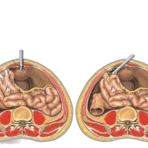 jewelry, illustration, laparoscopic, surgery transparent PNG cut-out