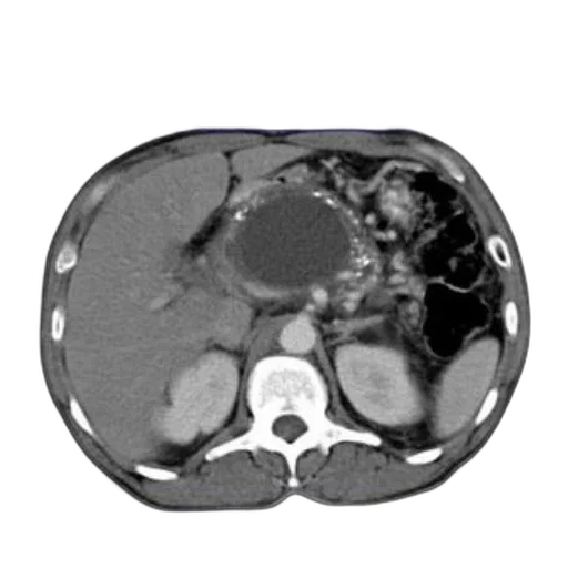 crown, scan, abdomen, showing transparent PNG cut-out