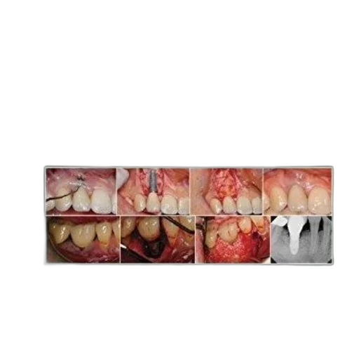 crown, cover, dental, implant transparent PNG cut-out
