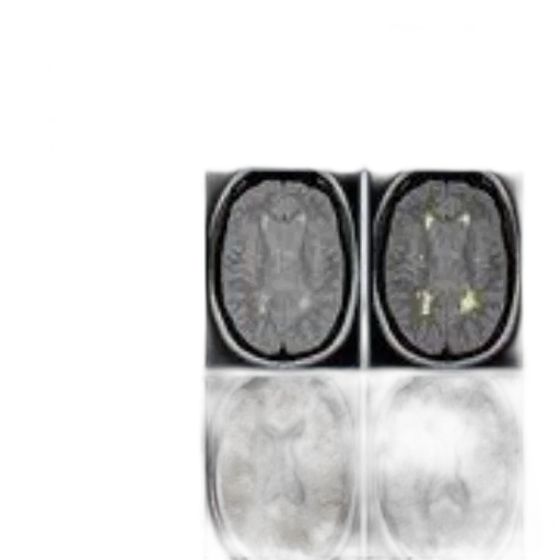 crown, multiple, sclerosis, therapeutics transparent PNG cut-out