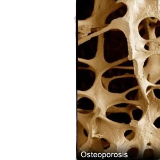 comparison, bone, density, healthy transparent PNG cut-out