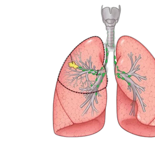 illustration, right, upper, lobectomy transparent PNG cut-out